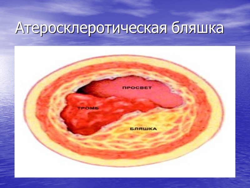 Атеросклеротическая бляшка